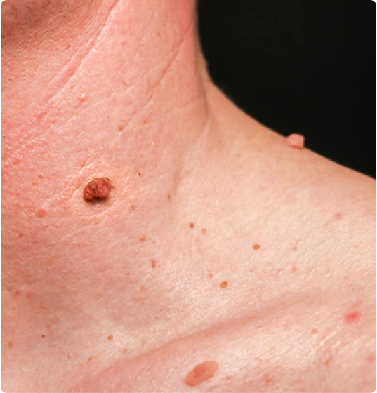 Benign skin conditions