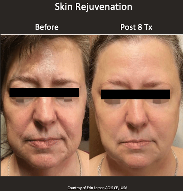 Clear skin pro rejuvenation