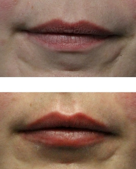 Laser lip Rejuvenation