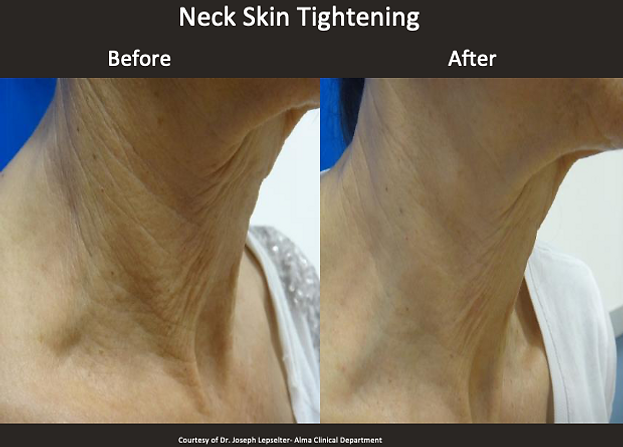 Neck Rejuvenation with softlift laser