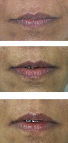 Needle free lip Symmeterisation