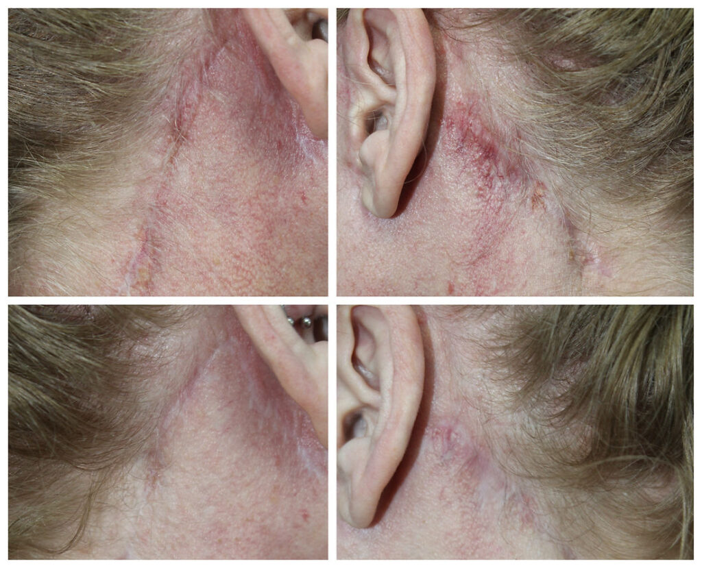 Post facelift Scar improvement