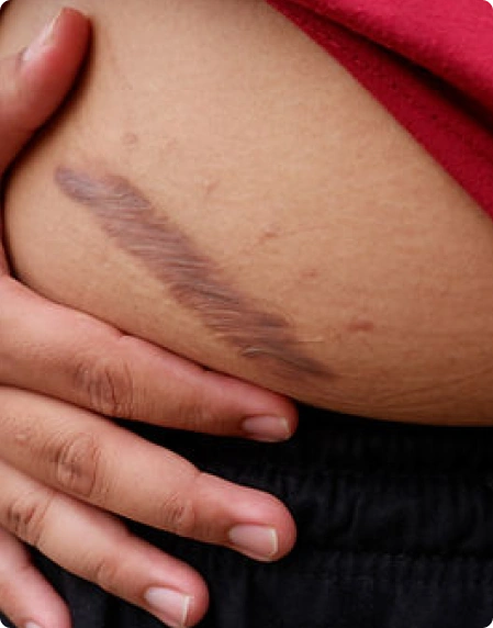 Scar Treatment Journey