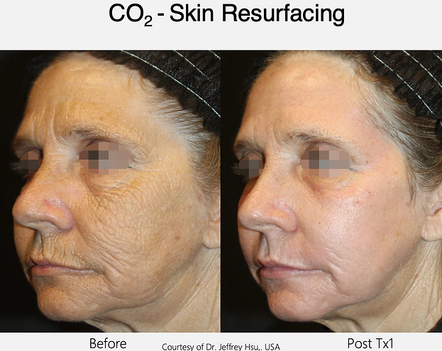 Skin Rejuvenation