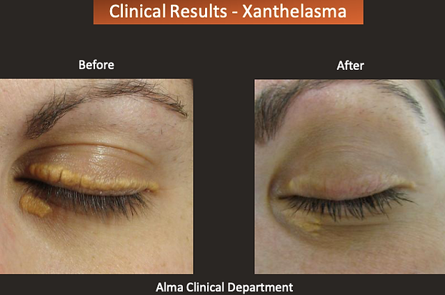 Xanthelasma correction Laser