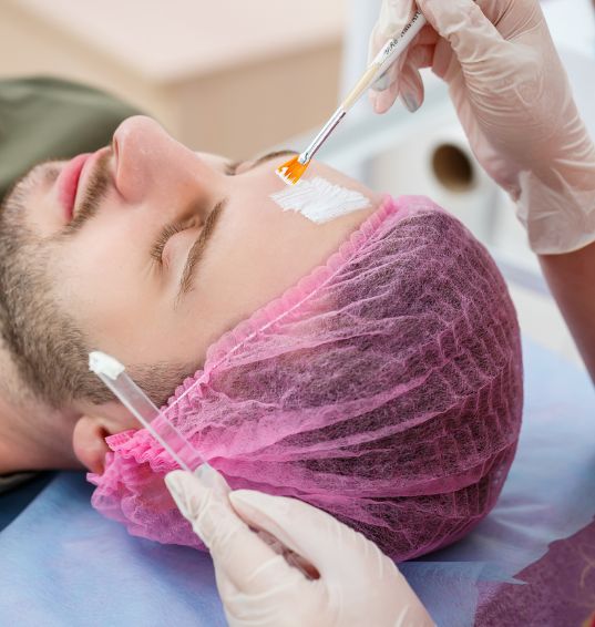 Chemical Peels