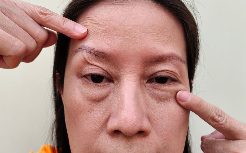 EYELID & EYE AREA AGEING