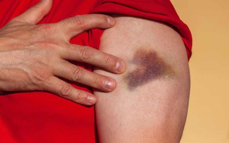 VASCULAR & THREAD VEINS
