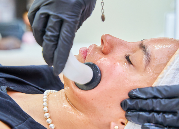 Melasma