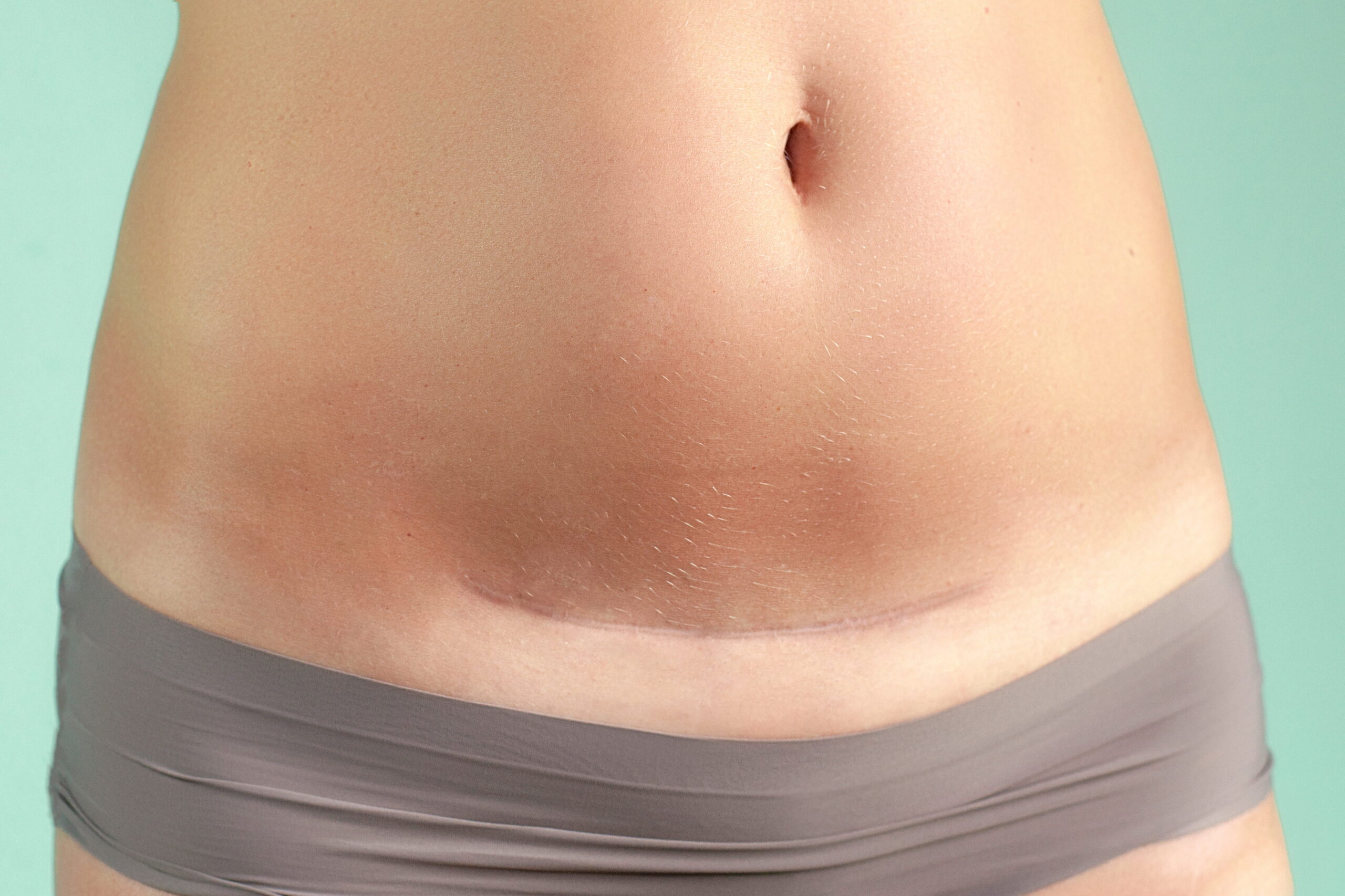 surgical scar