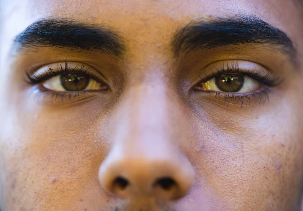 eyebrow droops