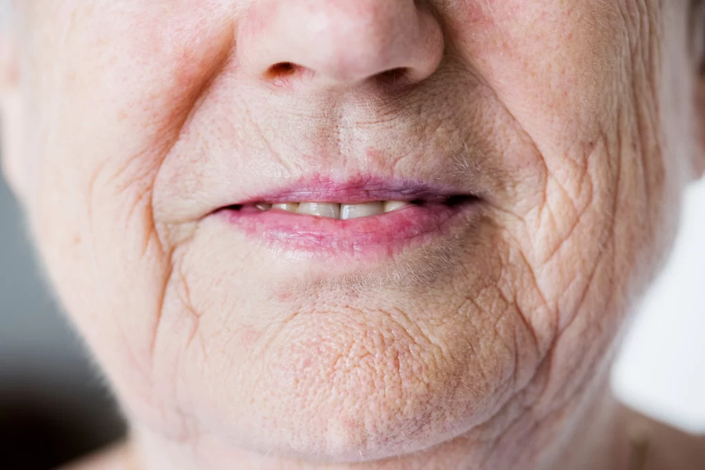 Prominent Deep Folds (Cheek/Mouth)