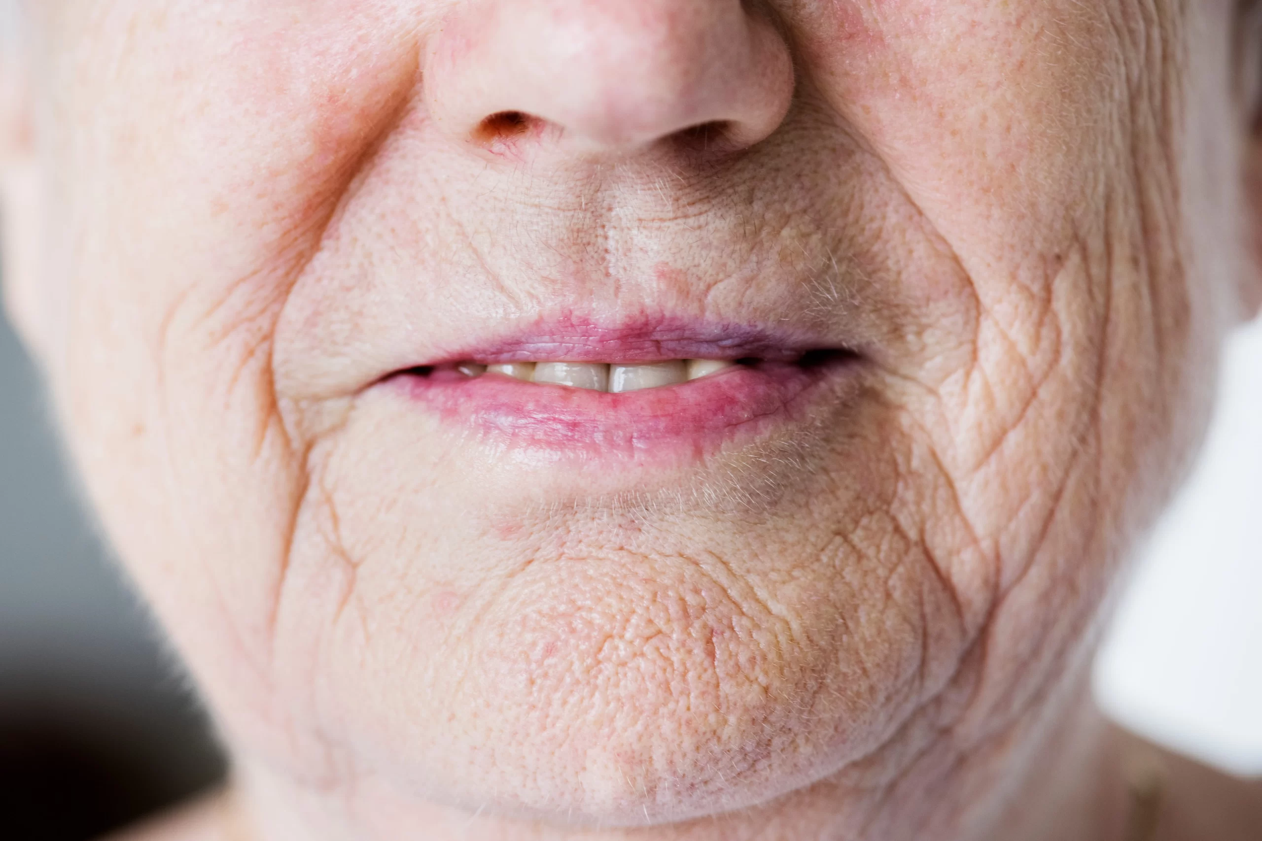 Prominent Deep Folds (Cheek/Mouth)