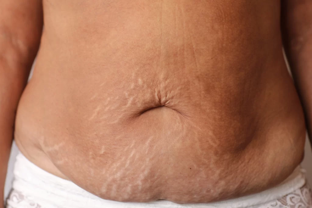 Crepey Abdominal Skin