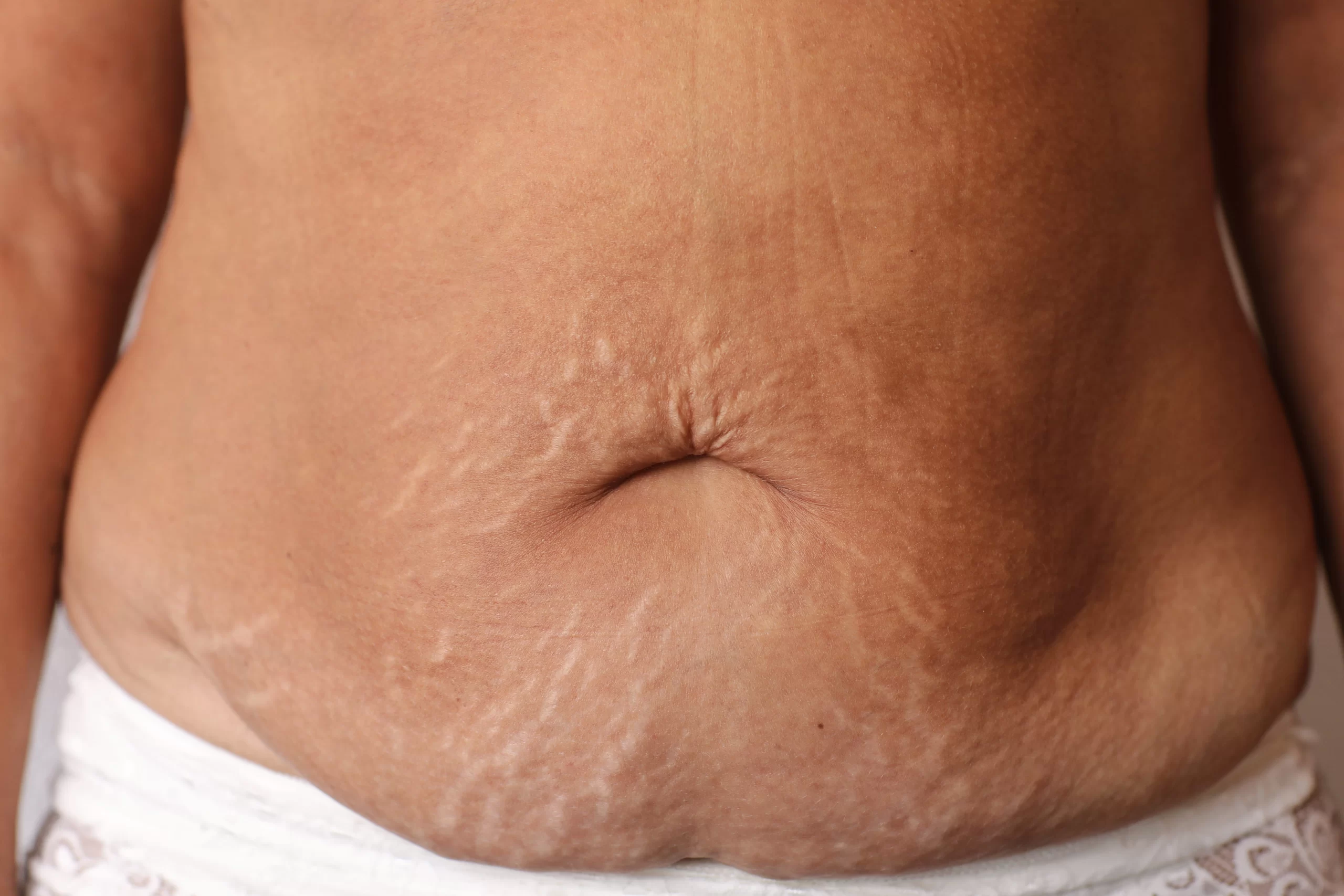 Crepey Abdominal Skin