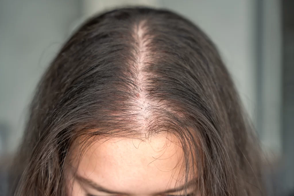 Hair Thinning