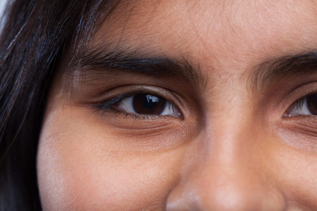 Under eye dark circles