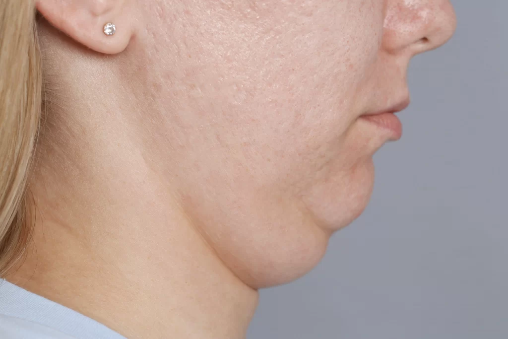 Turkey Neck