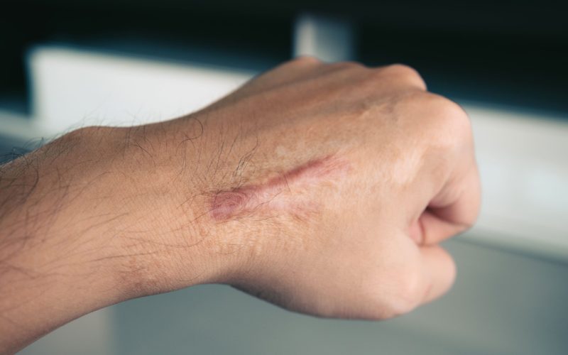 Hypertrophic Scars