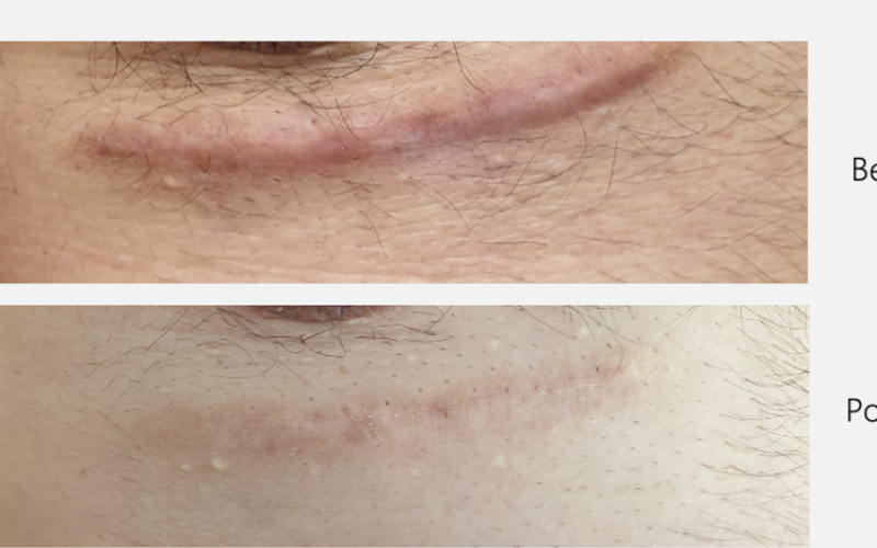 Laser Scar Treatment