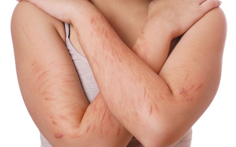 Managing Self-Harm Scares