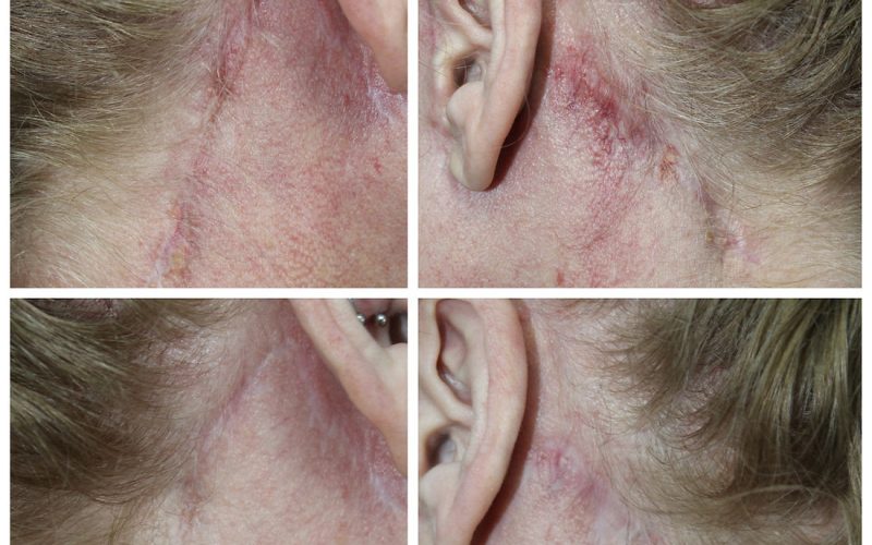 Post facelift Scar improvement