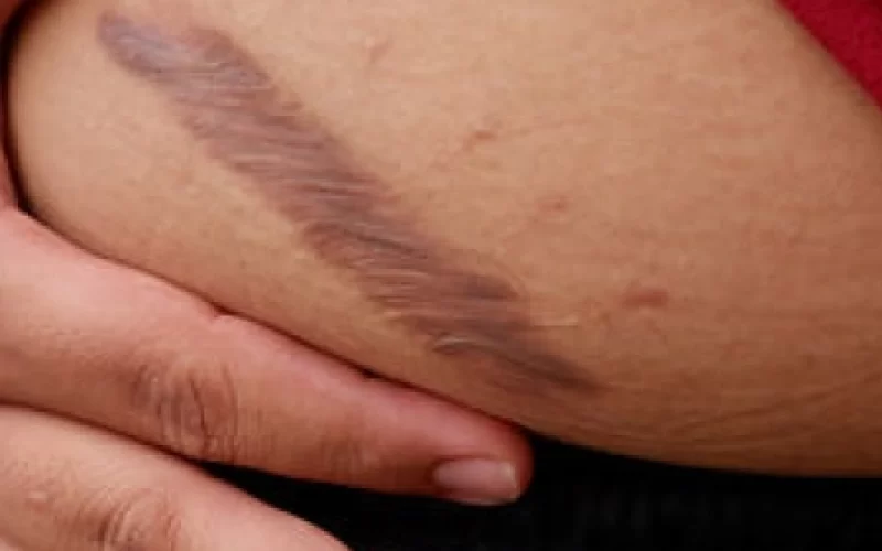 Scar Treatment Journey