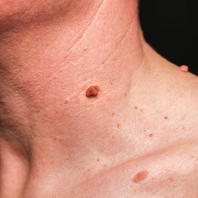 Close-up of a neck showing a small, brown raised mole with textured skin.