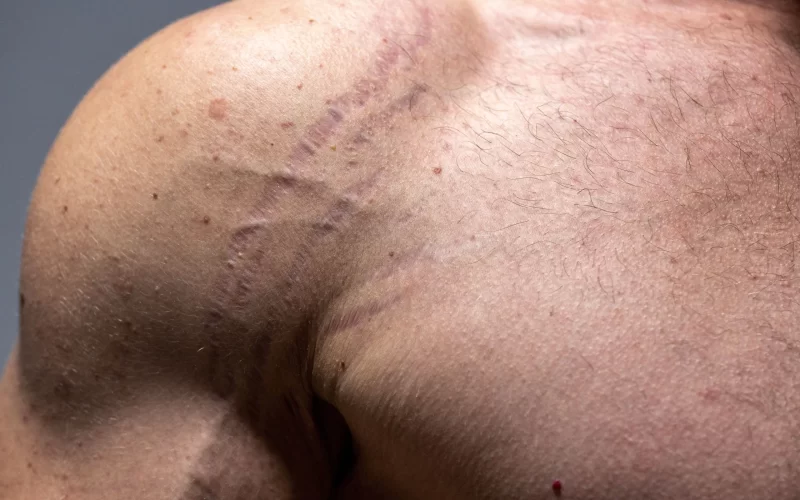 Depressed/atrophic scars