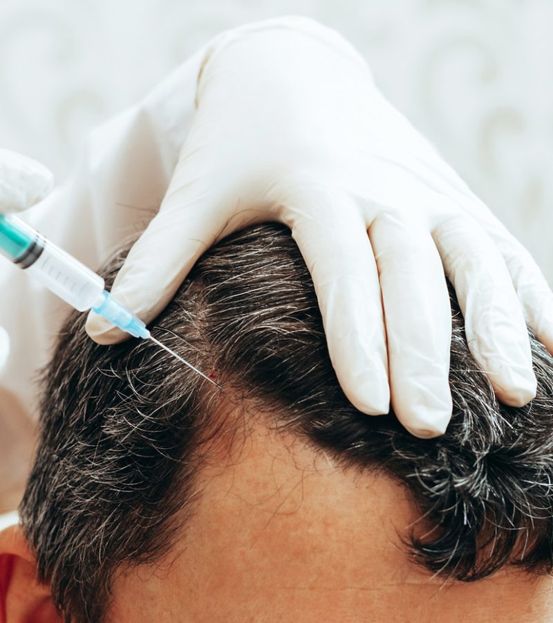 hair-restoration