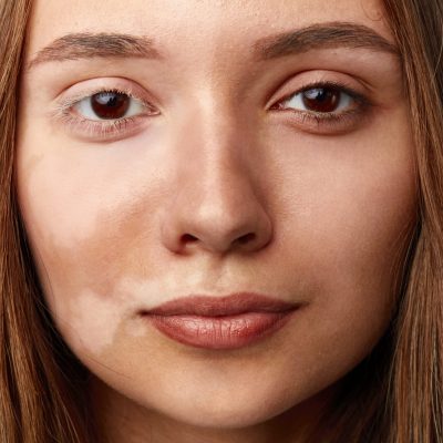 pigmentation-scar-treatment