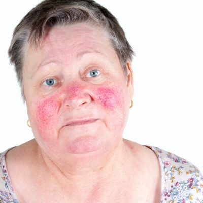 rosacea